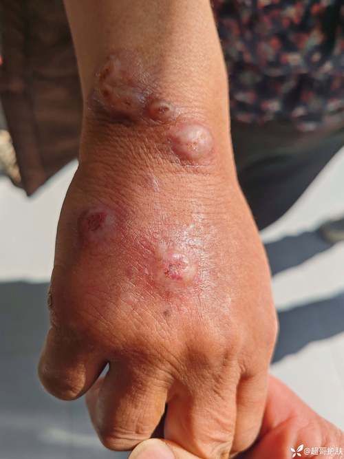 察哈尔右翼中旗：草原屏障下的低感染样本_57963